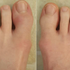腫腫的腳趾竟是乾癬引起的！乾癬也會關節炎。